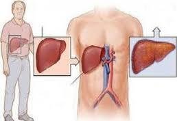 Элэгний эмгэгийн талаар сургалт зохиогдож байна