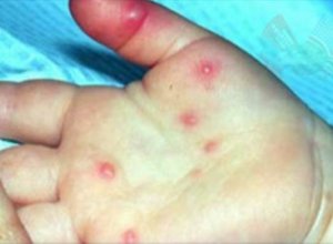 Улаанбурханы сэжигтэй тохиолдол 616 хүрчээ