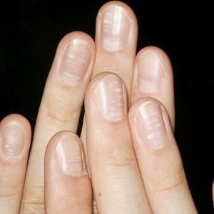 Хумсан дотрох цагаан толбо юу гэсэн үг вэ