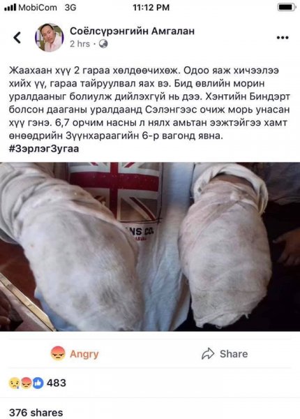 Хурдан морь унаж яваад хоёр гараа хөлдөөсөн гэх хүү ХССҮТ-ийн түлэнхийн тасагт эмчлүүлж байна