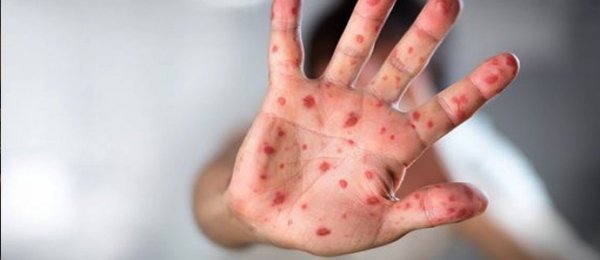 Улаанбурхан дэлхий дээр хамгийн хурдан тархдаг өвчнөөр бүртгэгджээ