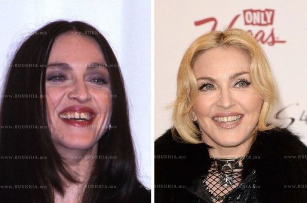 ''Hollywood smile” одуудын өмнө ба одоо