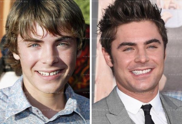 ''Hollywood smile” одуудын өмнө ба одоо