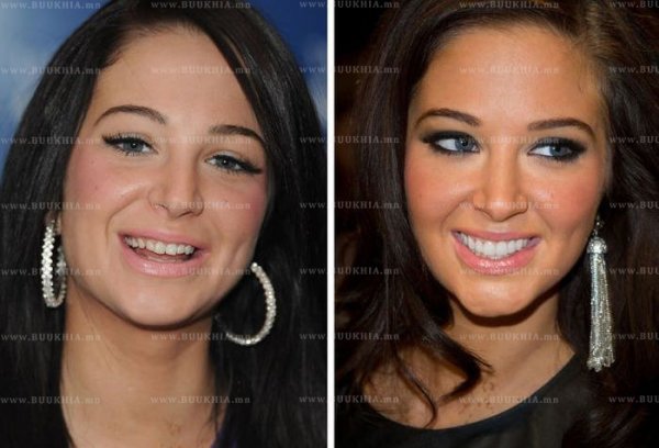 ''Hollywood smile” одуудын өмнө ба одоо