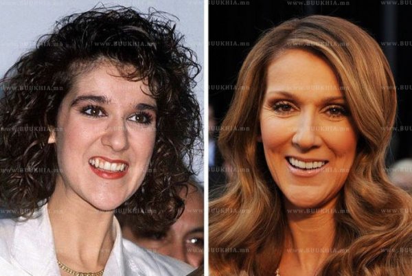 ''Hollywood smile” одуудын өмнө ба одоо