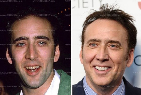 ''Hollywood smile” одуудын өмнө ба одоо