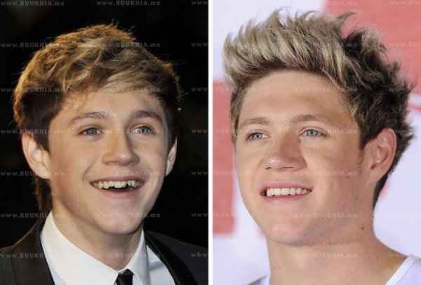 ''Hollywood smile” одуудын өмнө ба одоо