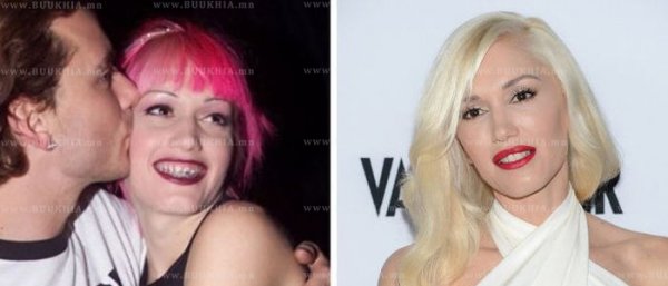 ''Hollywood smile” одуудын өмнө ба одоо
