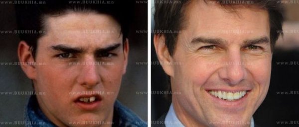 ''Hollywood smile” одуудын өмнө ба одоо