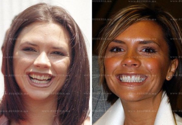 ''Hollywood smile” одуудын өмнө ба одоо