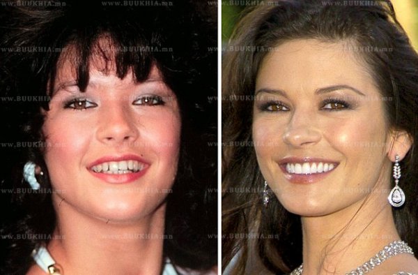 ''Hollywood smile” одуудын өмнө ба одоо