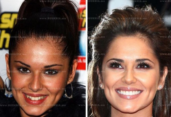 ''Hollywood smile” одуудын өмнө ба одоо
