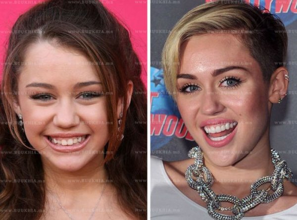 ''Hollywood smile” одуудын өмнө ба одоо