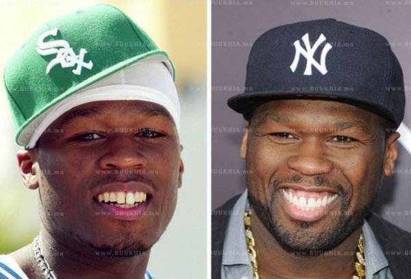 ''Hollywood smile” одуудын өмнө ба одоо