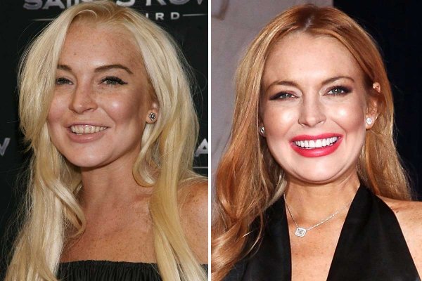 ''Hollywood smile” одуудын өмнө ба одоо