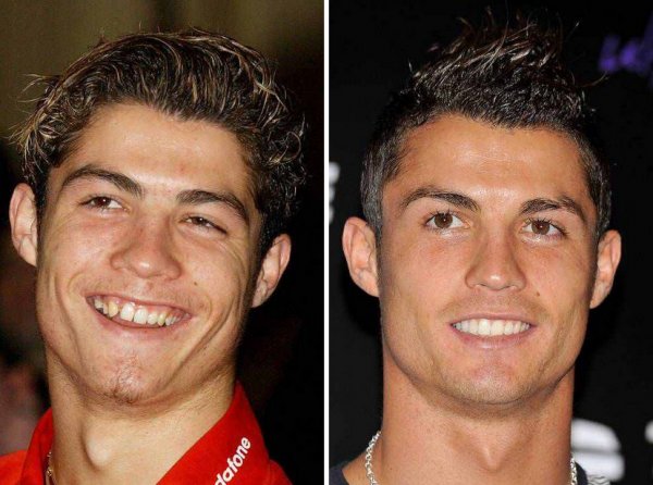 ''Hollywood smile” одуудын өмнө ба одоо